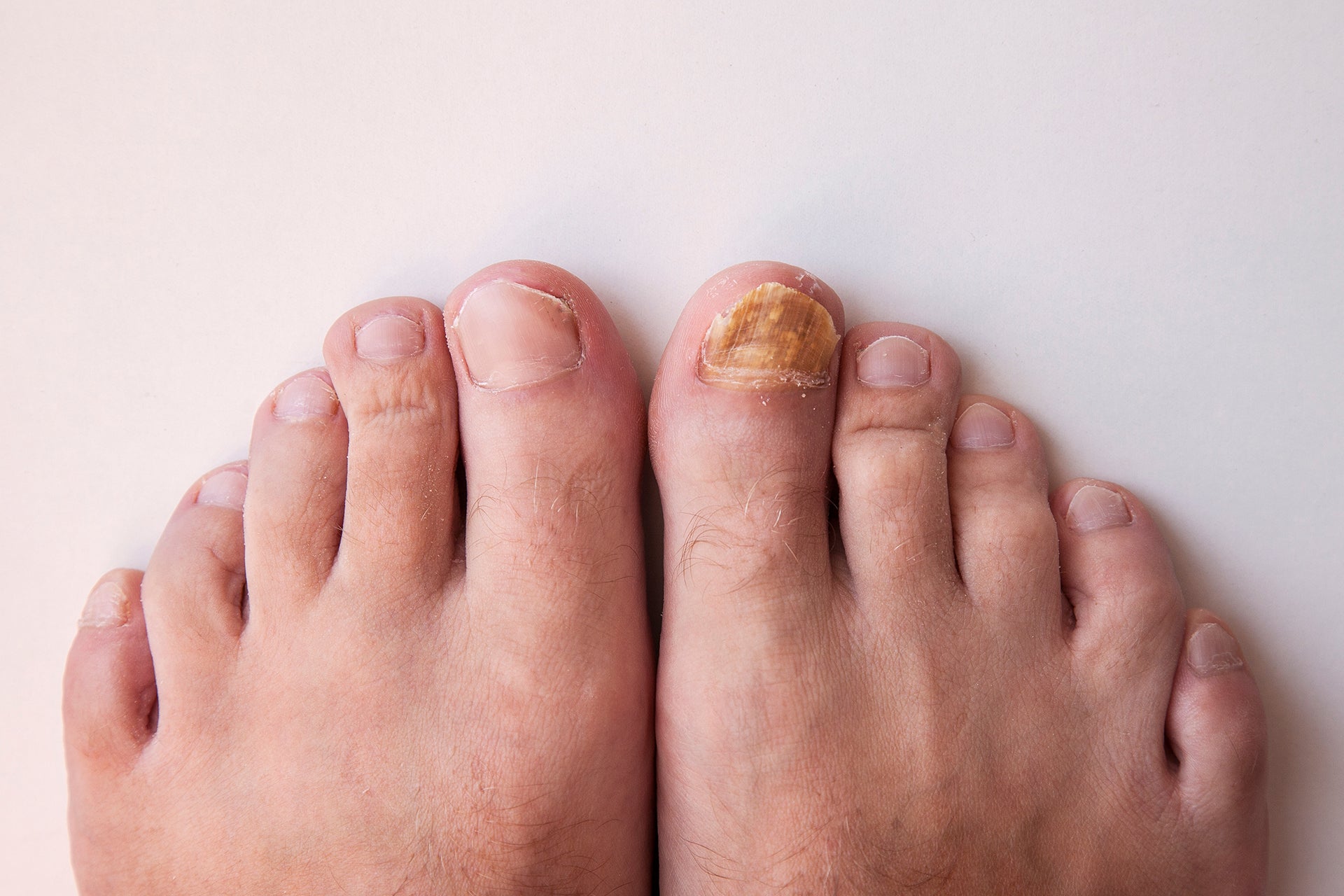TOENAIL FUNGUS: What it is, why it happens & footcare tips that may help
